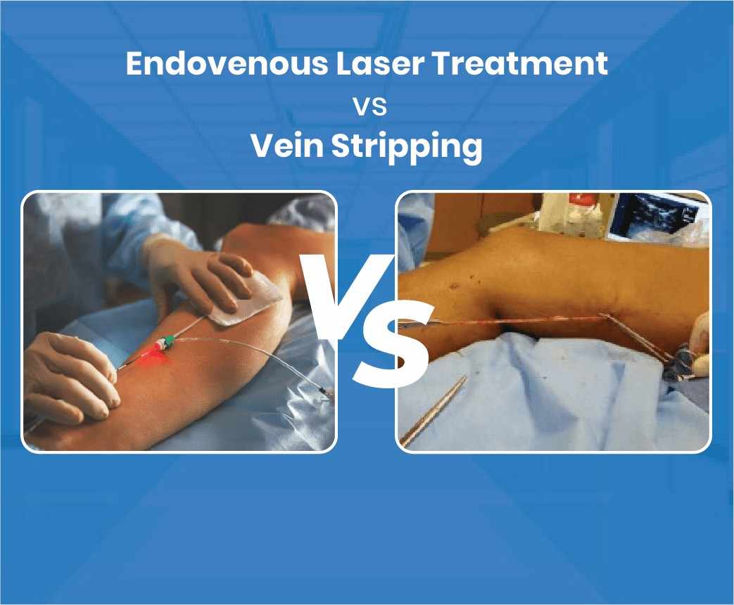 Endovenous Laser Treatment vs. Vein Stripping