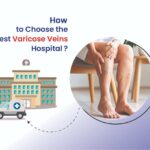 how to choose a best varicose veins hospital