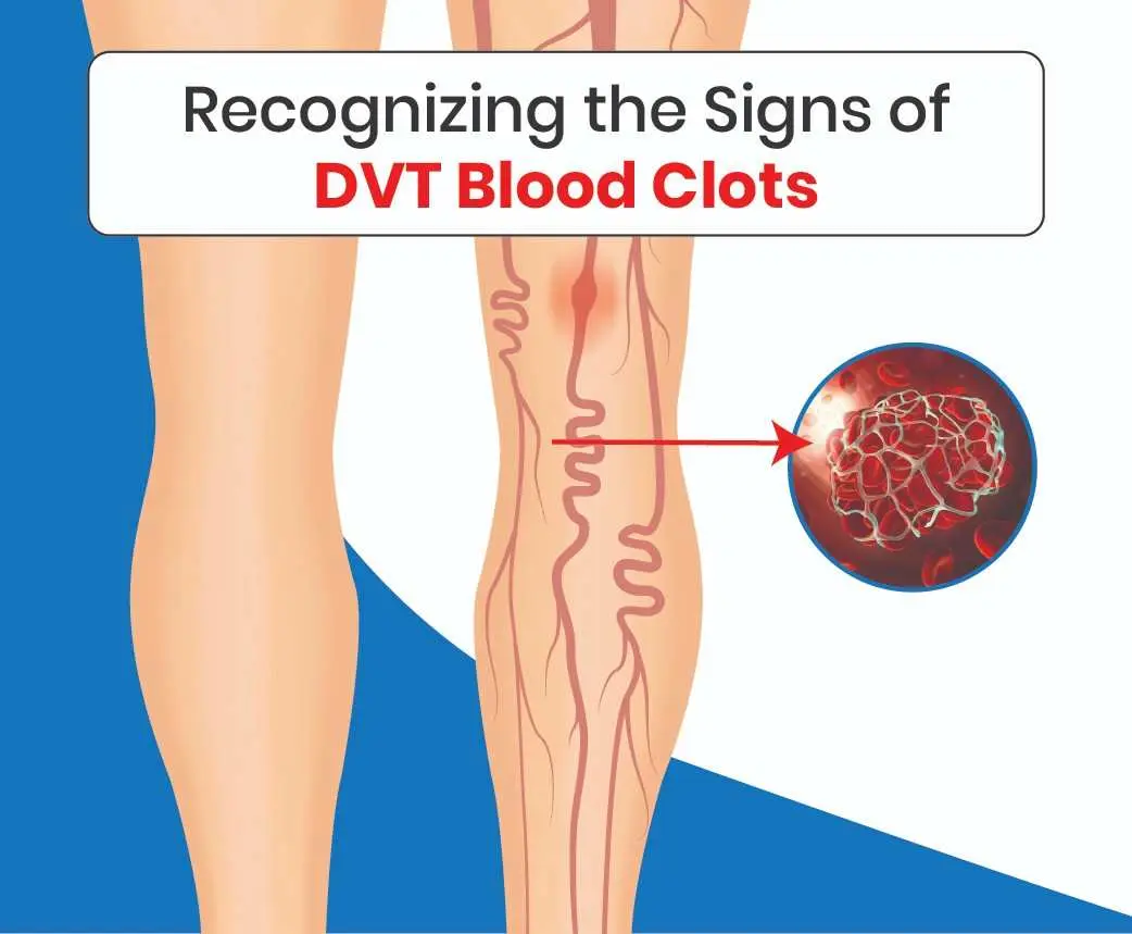 Signs of DVT: Deep Vein Thrombosis Symptoms