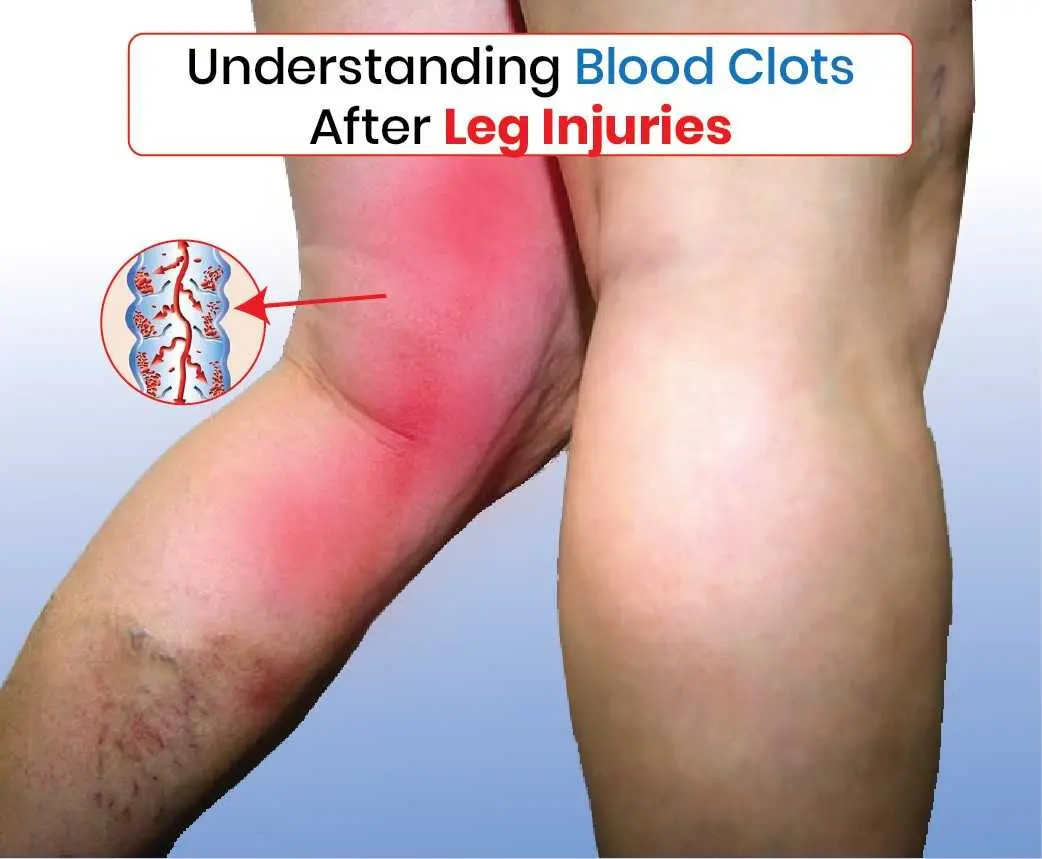Blood Clots After Leg Injury: Symptoms & Risks