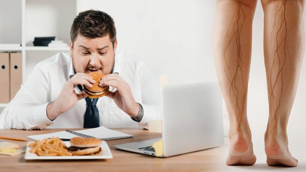 Lifestyle changes causing Varicose veins
