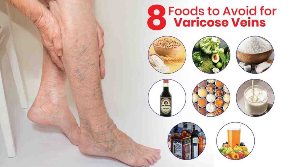 8 foods to avoid for varicose veins