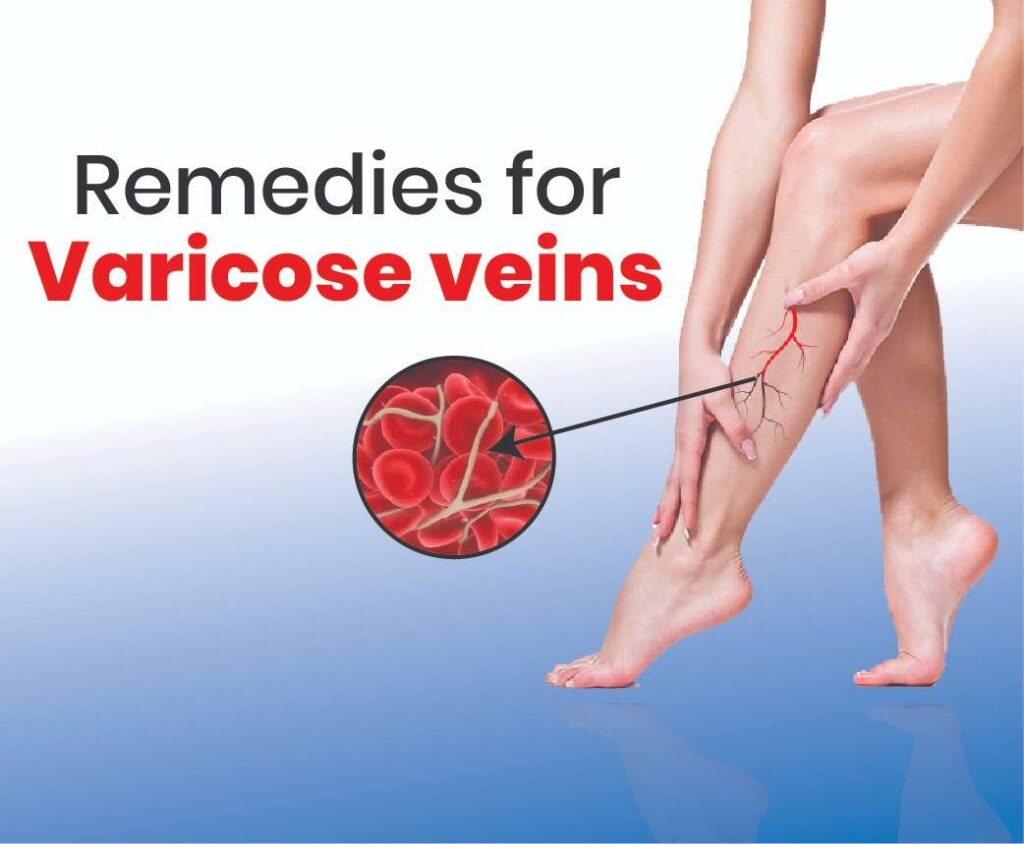 Varicose Veins to Remedy or to Treat