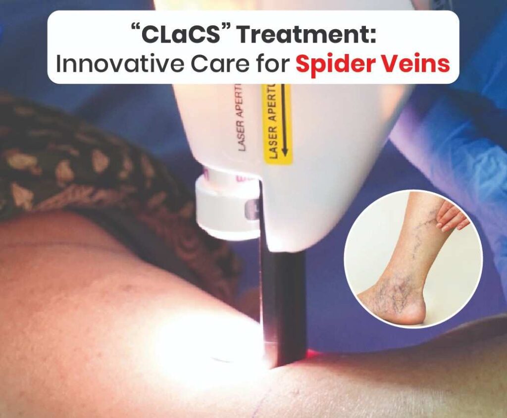 CLaCs Treatment innovative care for spider veins