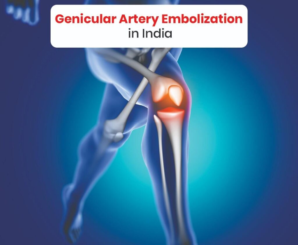 Genicular Artery Embolization in india