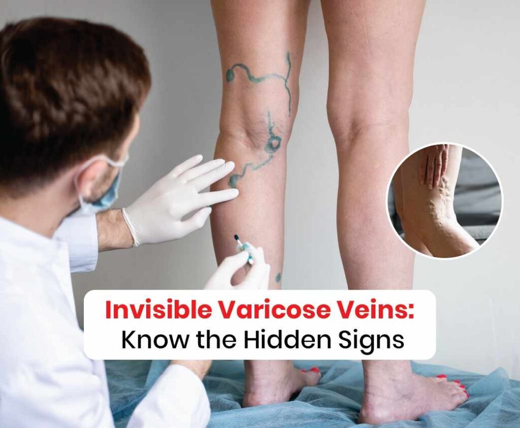 Invisible varicose veins Know the hidden facts