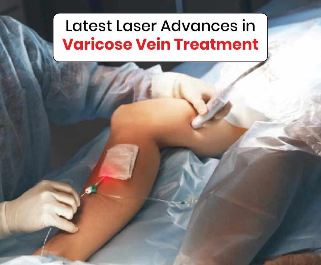Laser therapy for Varicose veins