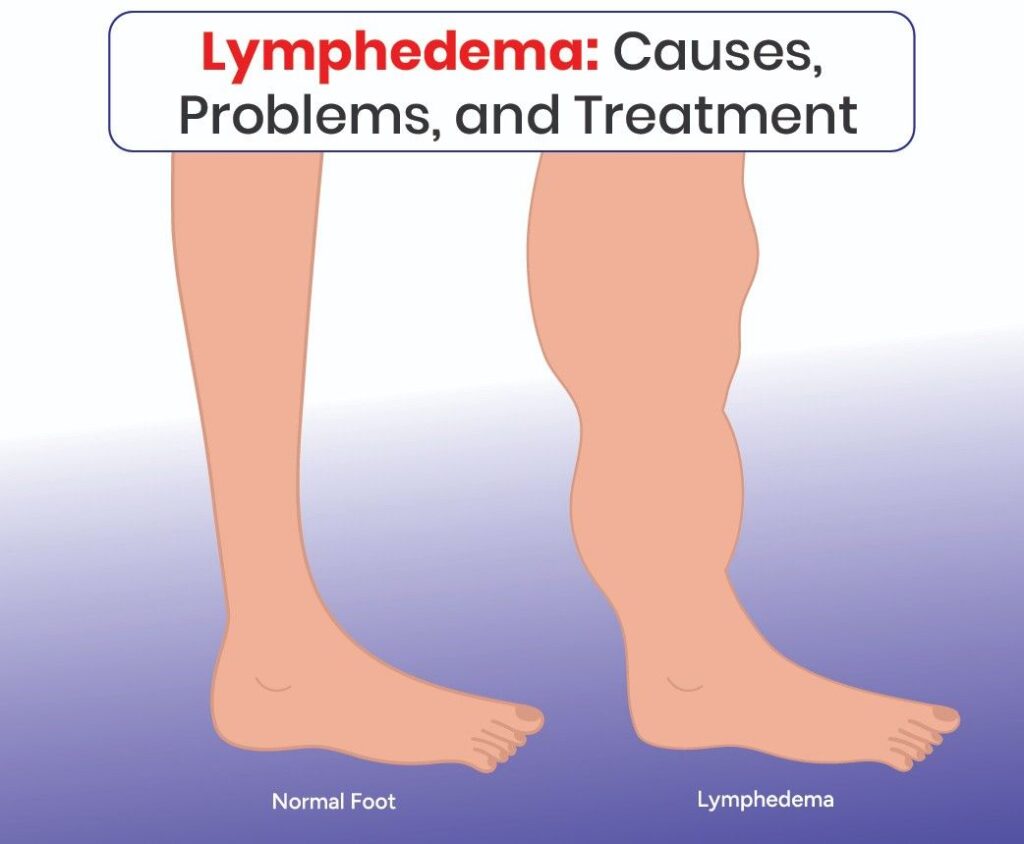 Lymphedema Causes Problems and Treatments