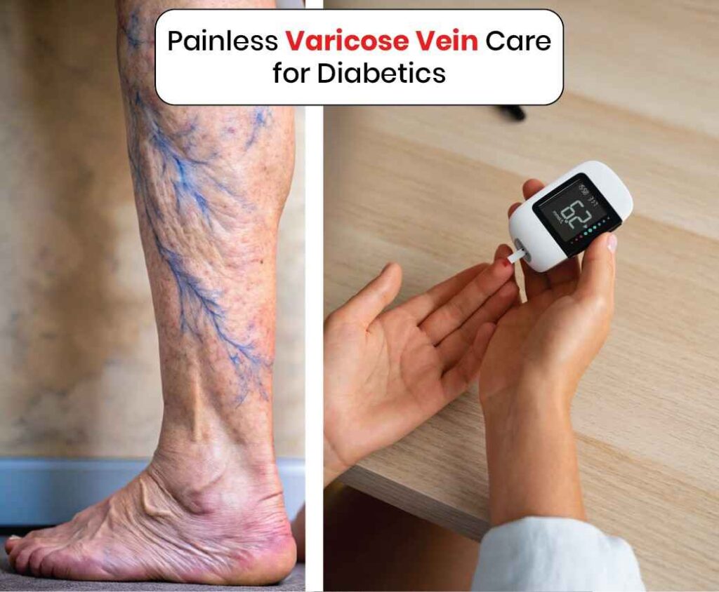 Painless Varicose Vein Care for Diabetics