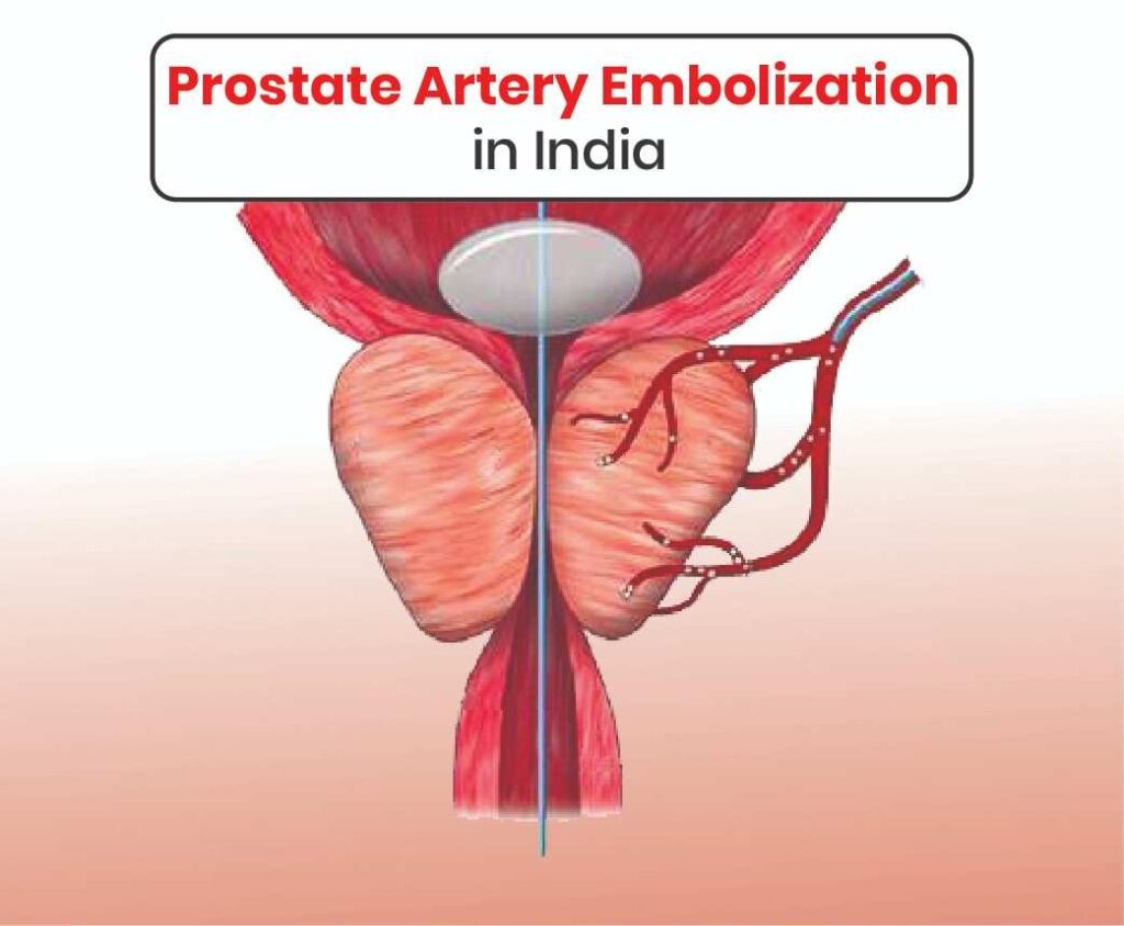 Prostate Artery Embolization in India