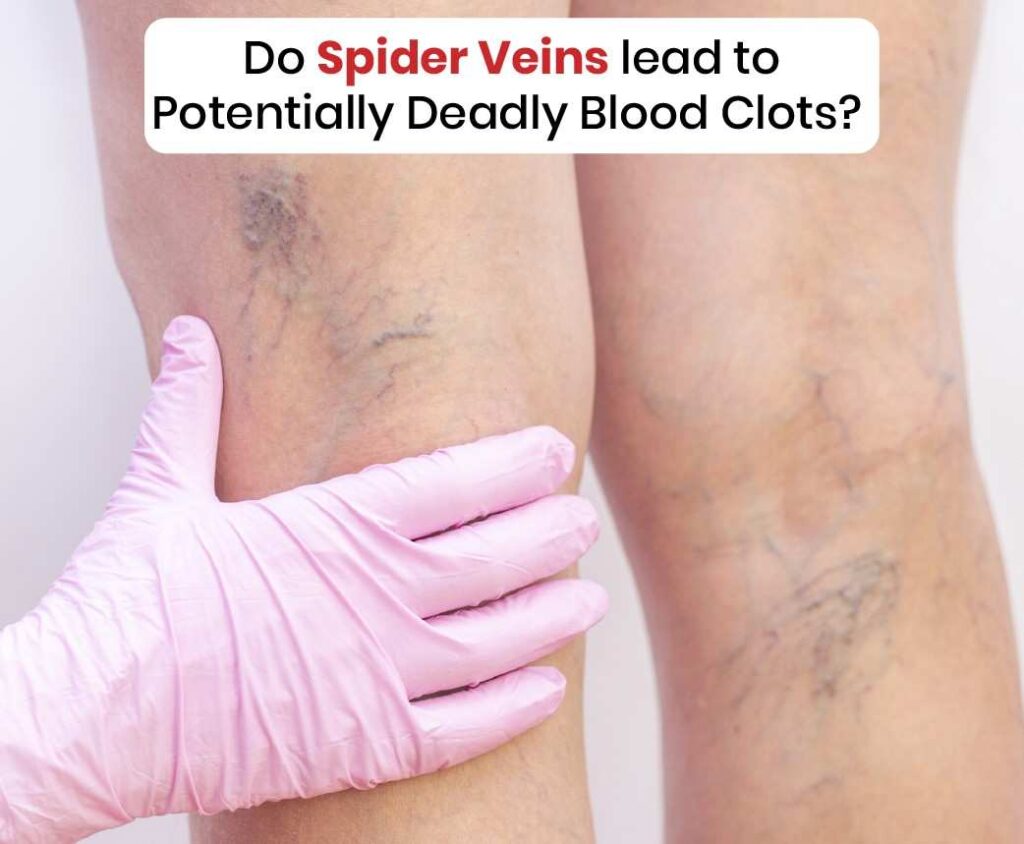 Spider veins lead to potentially deadly blood cloths