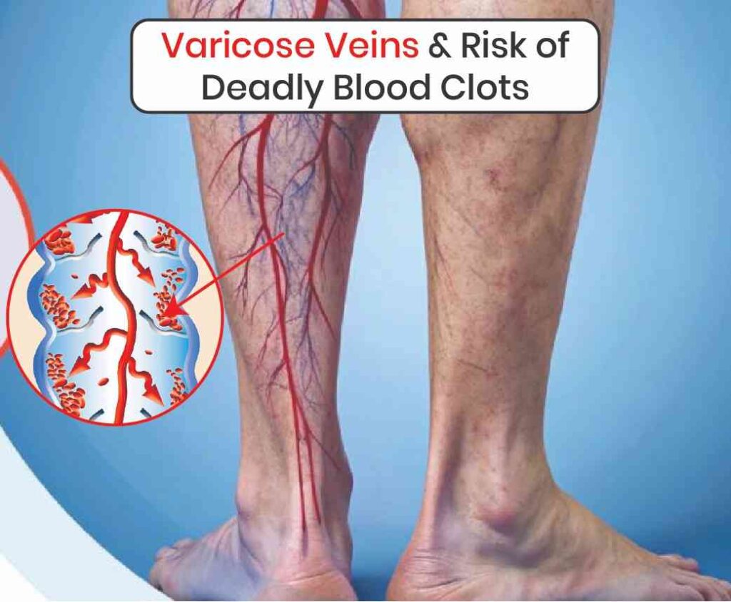Varicose Veins & Risk of Deadly Blood Clots