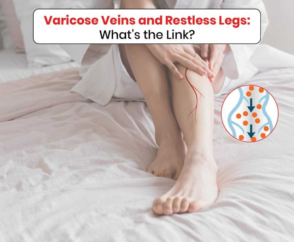 Varicose veins and restless legs whats the link