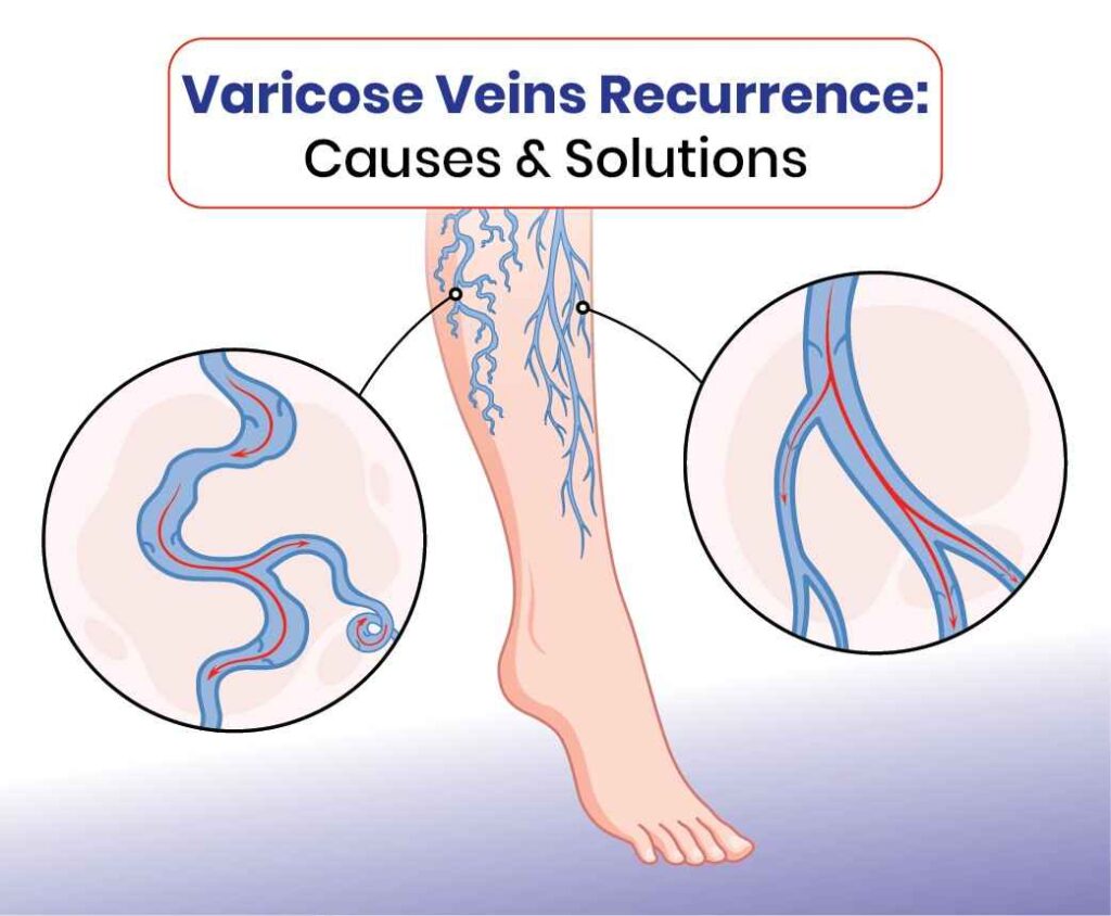 Varicose veins recurrence causes solutions