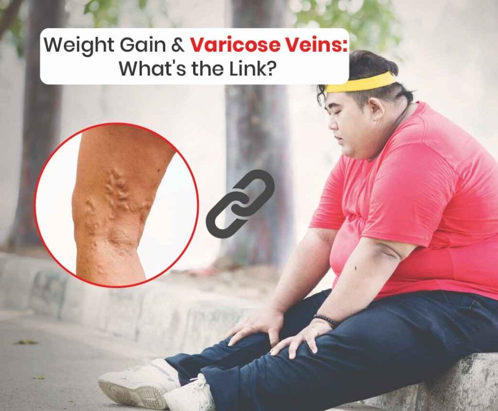 Weight gain varicose veins what's the link