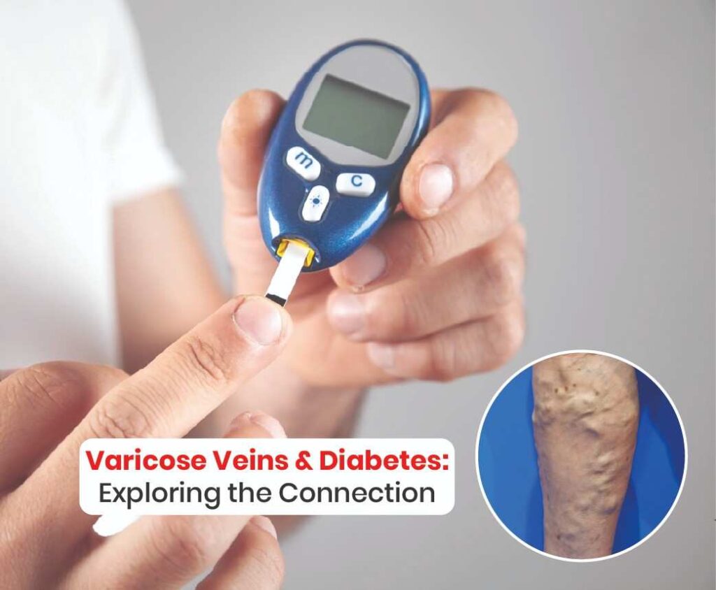 varicose veins and Diabetes exploring the connection