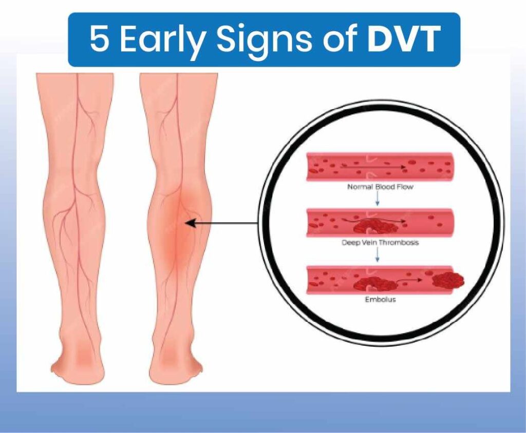 5 early signs of DVT