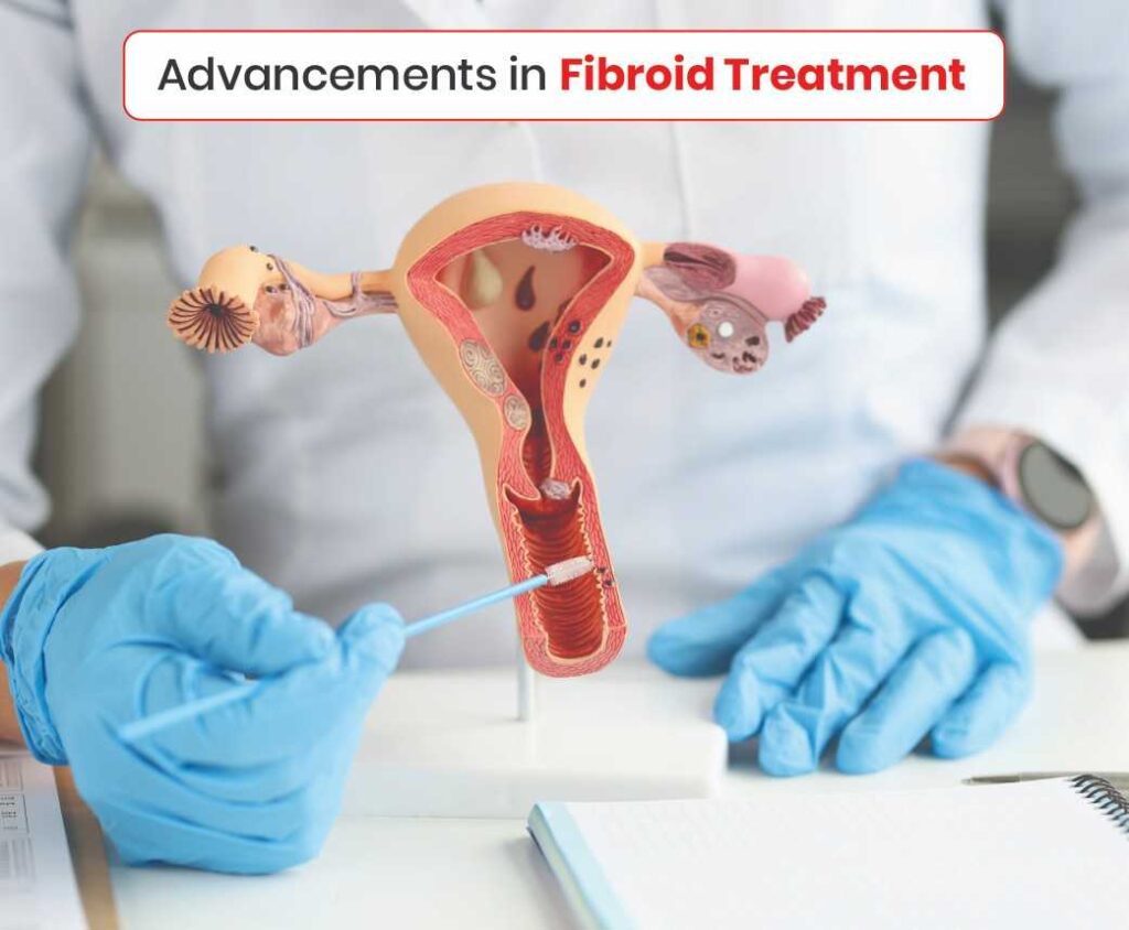 Advancements in fibroid treatment