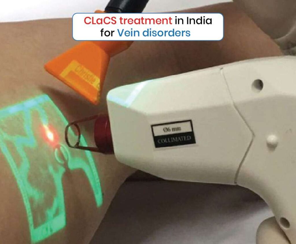 CLaCS Treatment in India For Vein Disorders