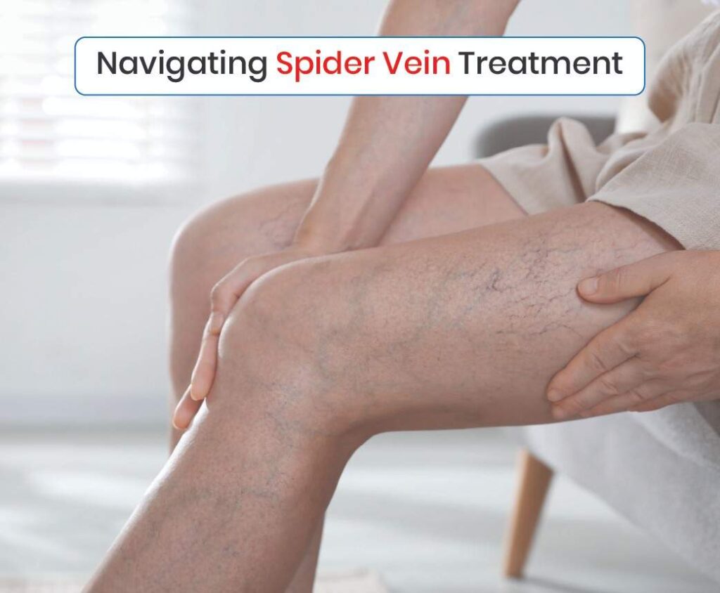 Navigating Spider Vein Treatment