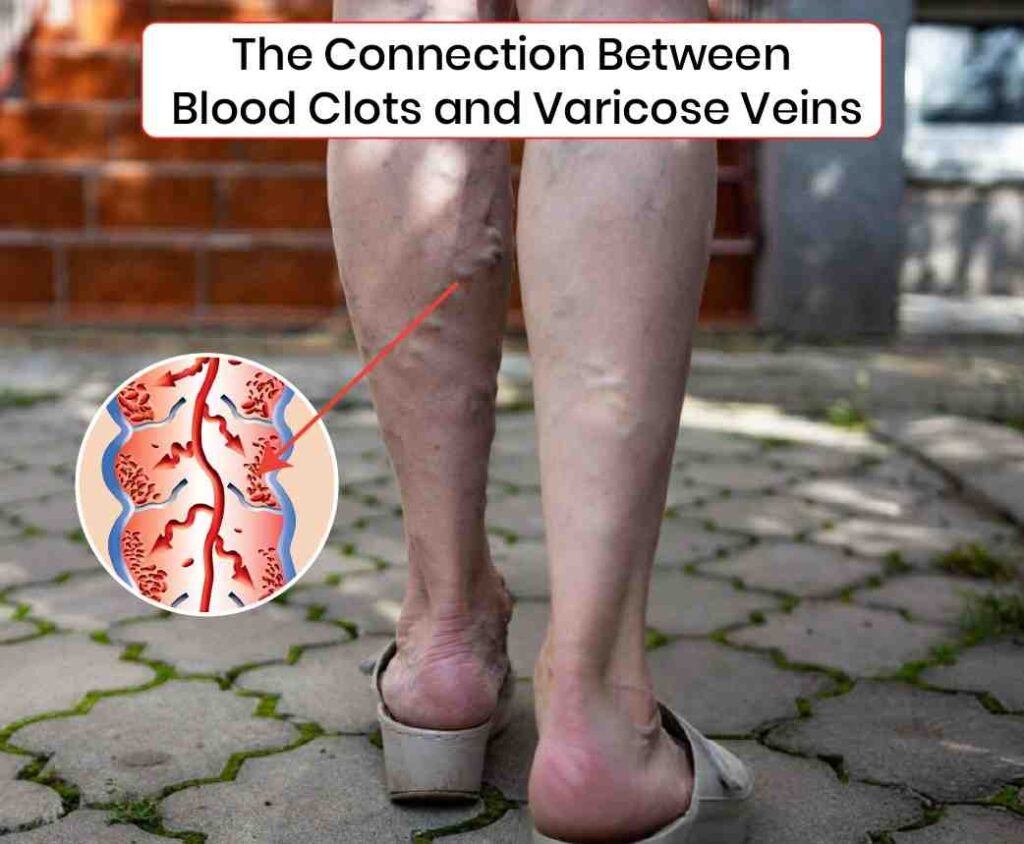 The Connection Between Blood cloths and Varicose Veins