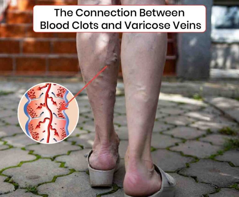 The Connection Between Blood cloths and Varicose Veins