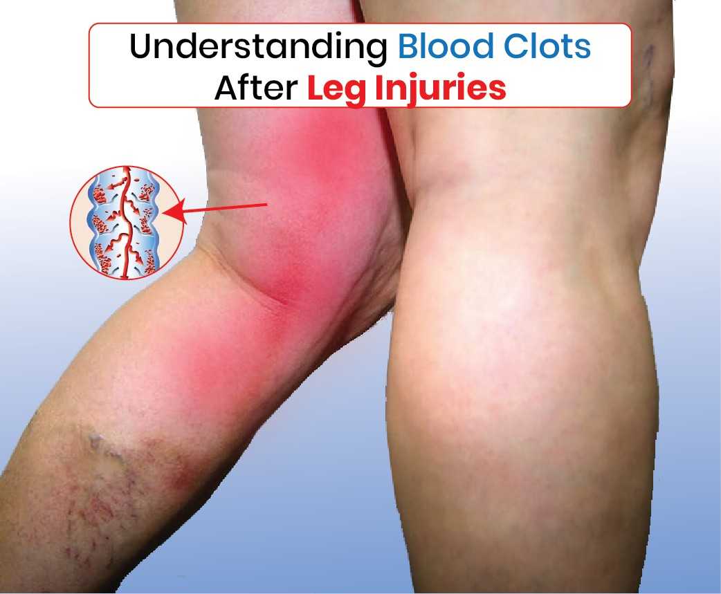 Understanding Blood Clots After Leg Injuries