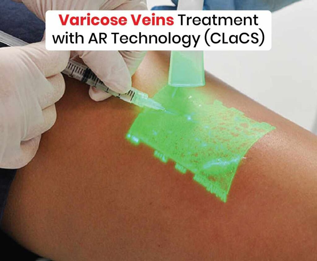 Varicose Veins Treatment with AR Technology (CLaCS)