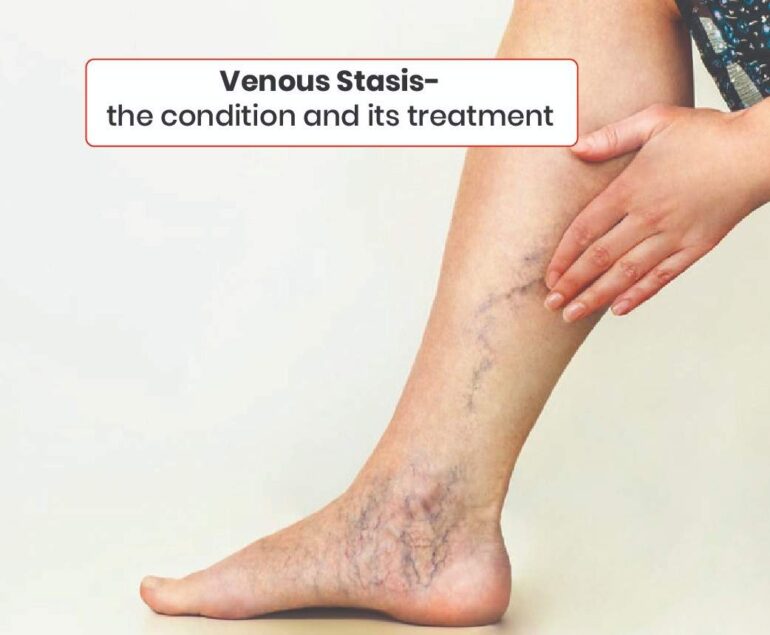 Venous stasis- the condition and its treatment