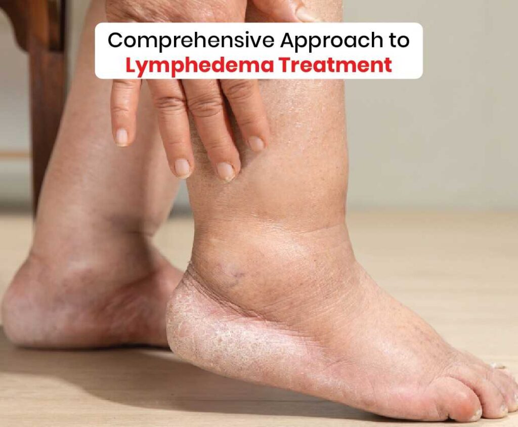 comprehensive approach to lymphedema treatment