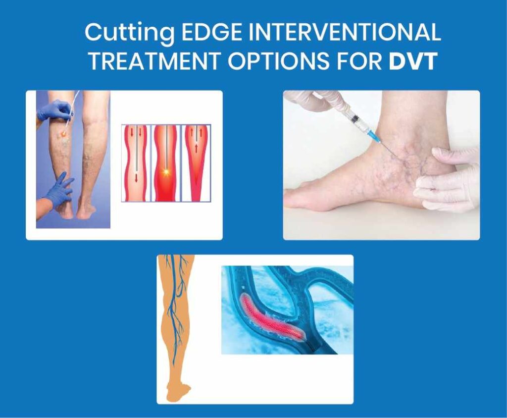 cutting edge interventional treatment options for dvt