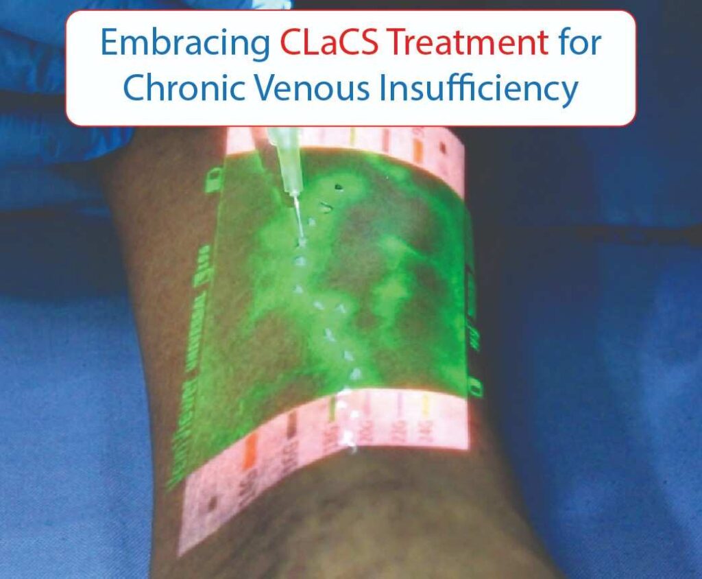 embracing clacs treatment for chronic venous insufficiency