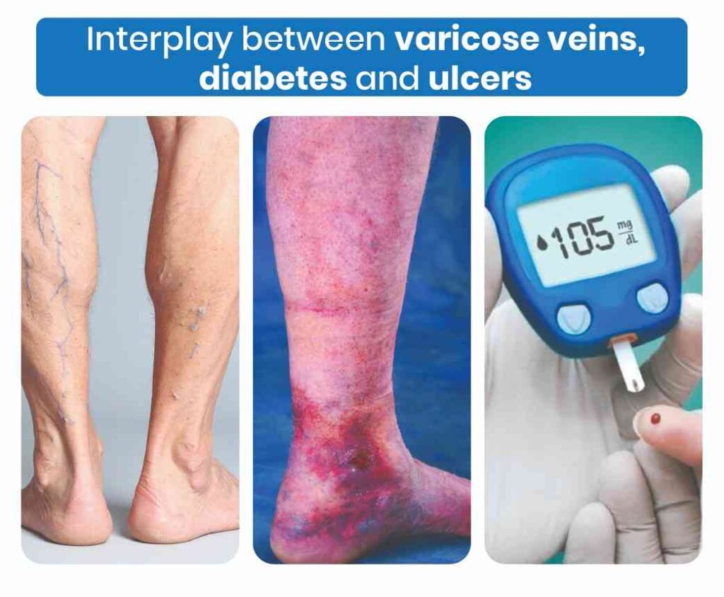 interplay between varicose veins, diabetes and ulcers
