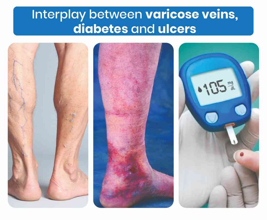 interplay between varicose veins, diabetes and ulcers