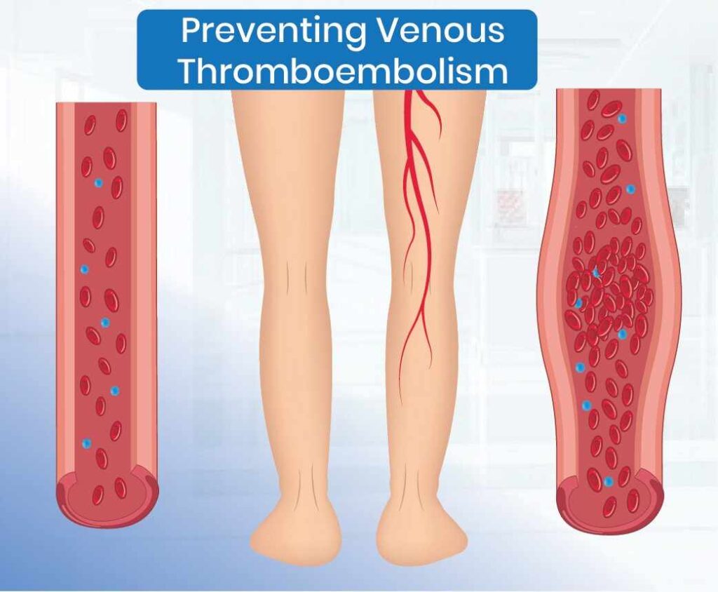 preventing venous thromboembolism