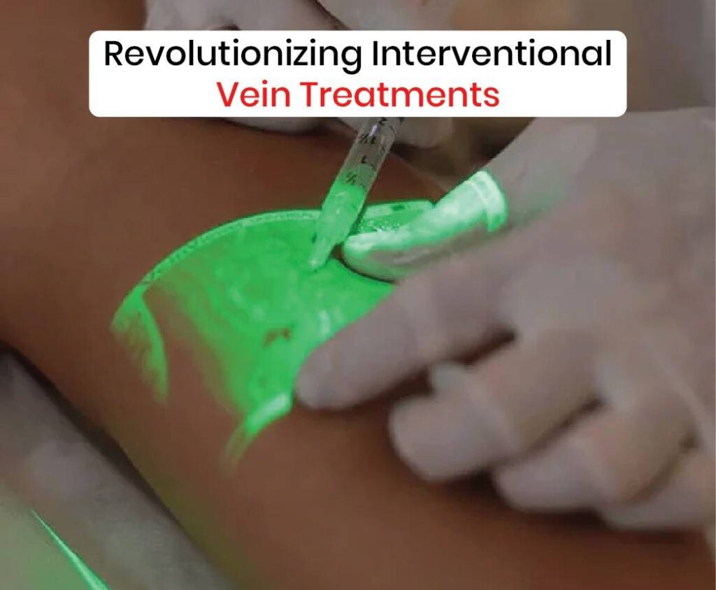 revolutionizing interventional vein treatments