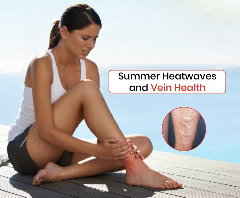 summer heatwaves and vein health