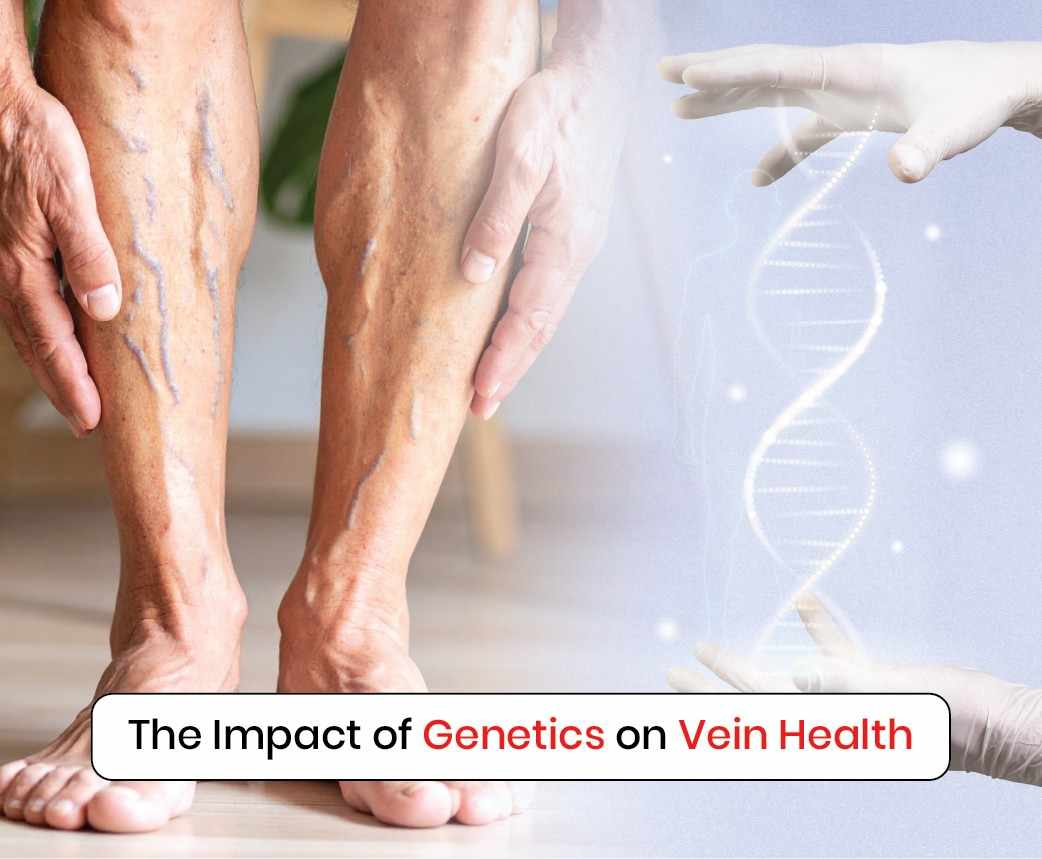 the impact of genetics on vein health