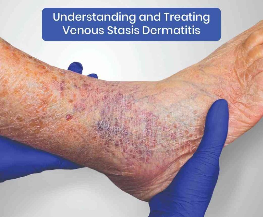 understanding and Treating venous stasis dermatitis