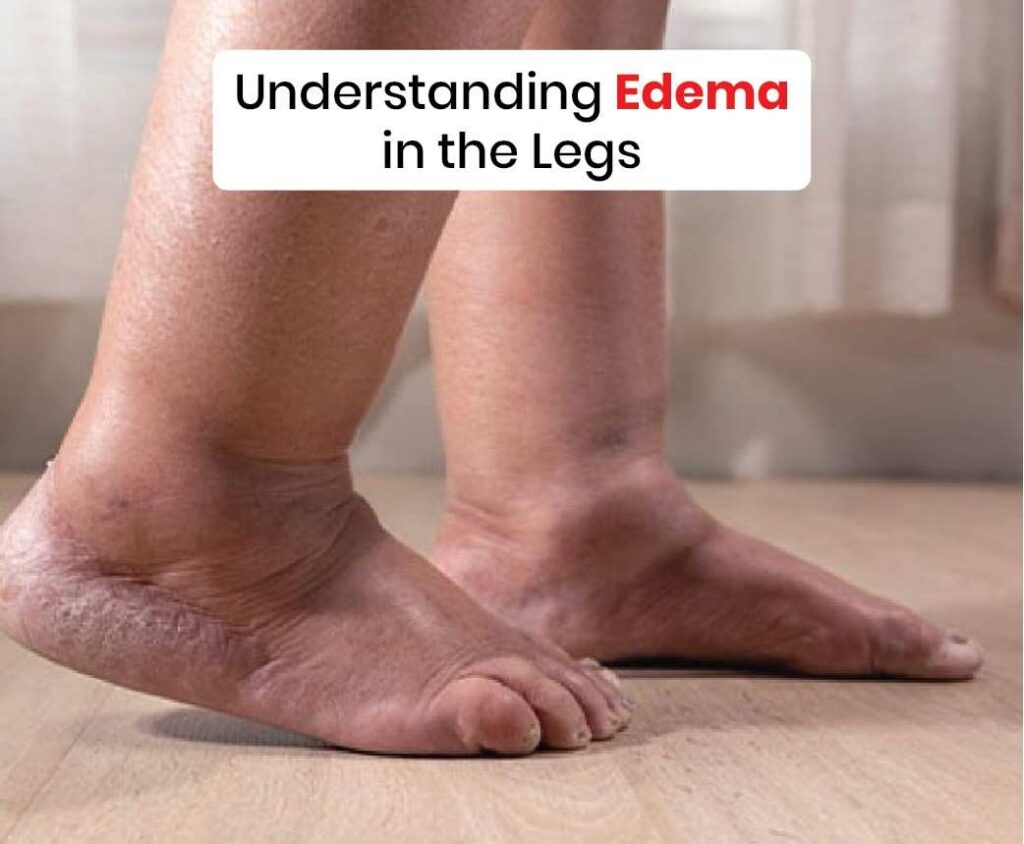 understanding edema in the legs