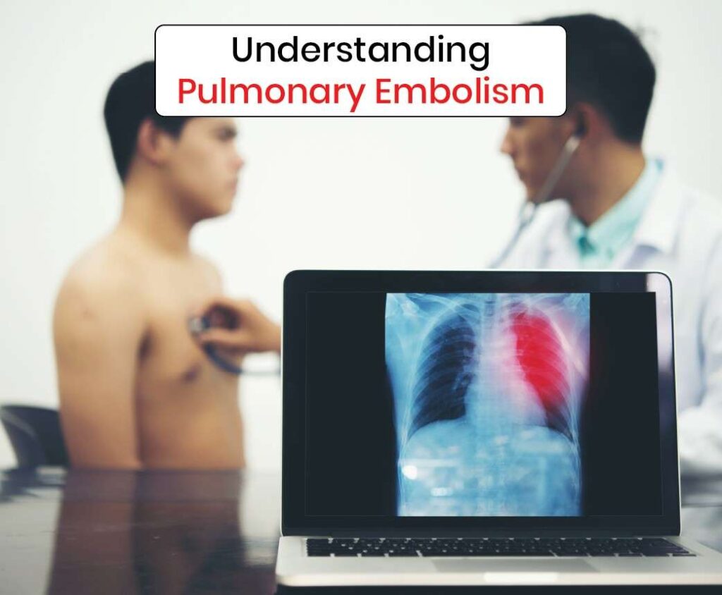 understanding pulmonary embolism