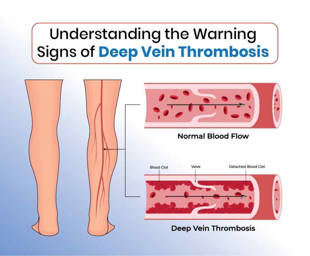 understanding the warning signs of deep vein thrombosis
