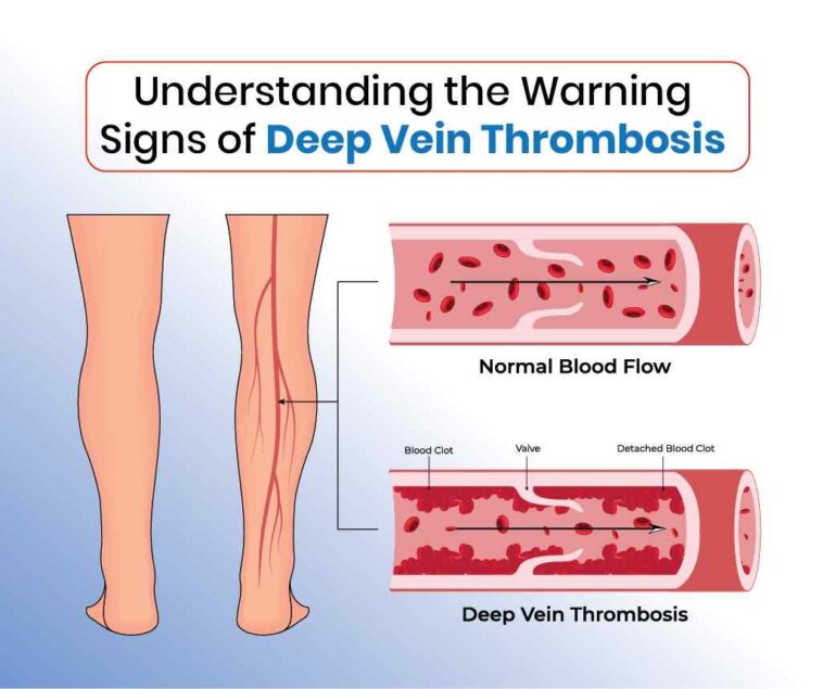 understanding the warning signs of deep vein thrombosis