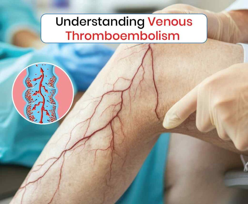 understanding venous thromboembolism