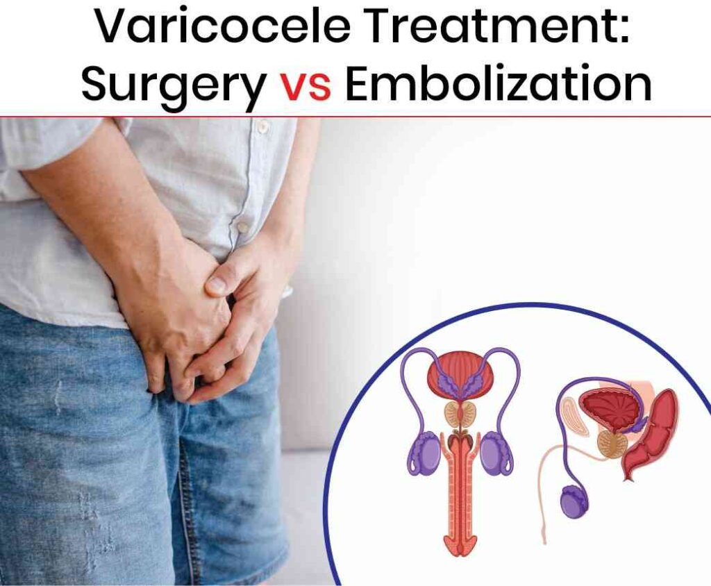 varicocele treatment surgery vs embolization