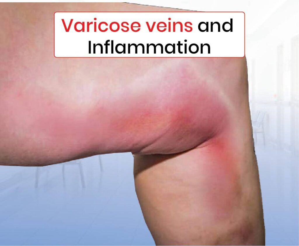 varicose veins and inflammation