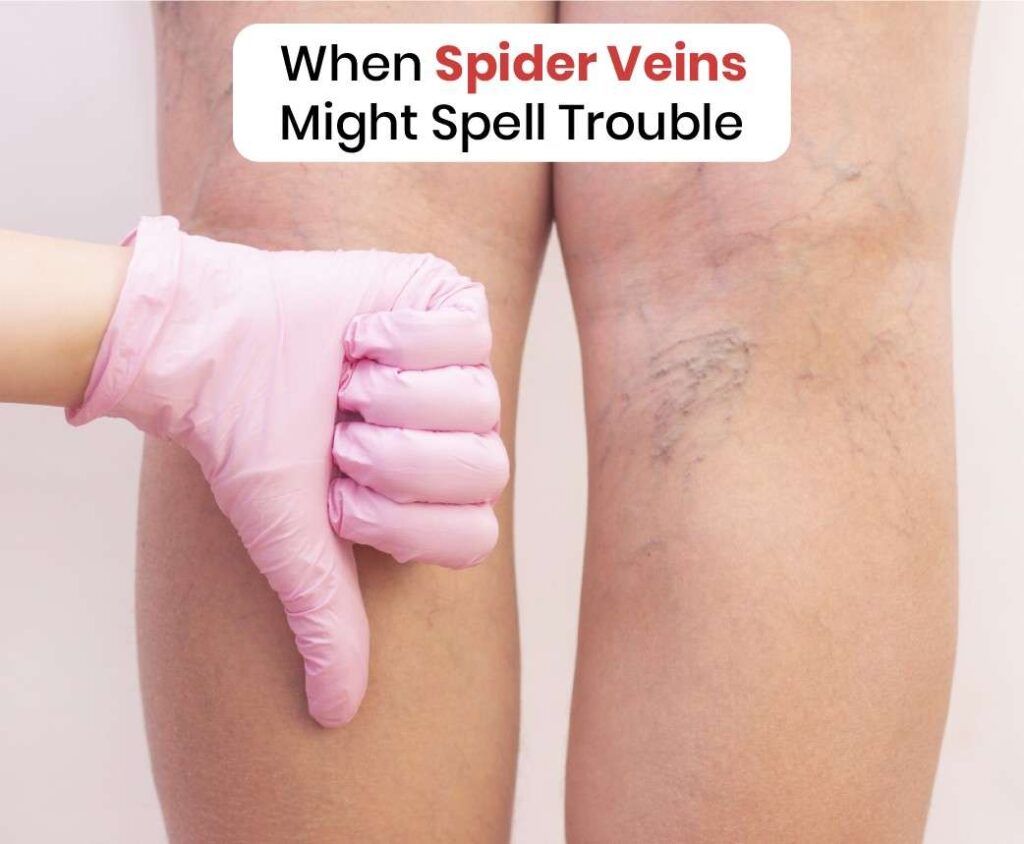 when spider veins might spell trouble