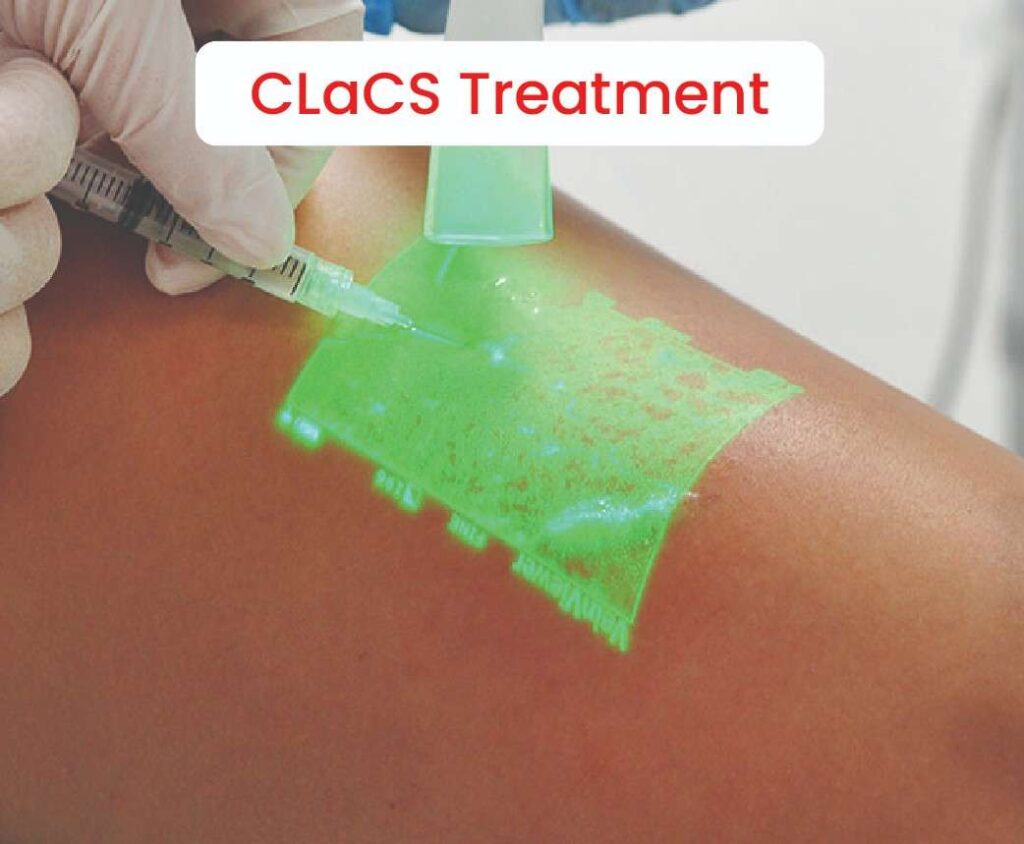 CLaCS Treatment