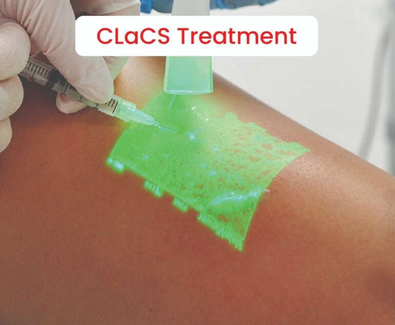 CLaCS Treatment