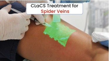 CLaCS Treatment for Spider Veins